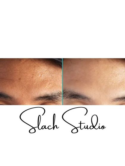 This before-and-after of the forehead shows how my treatments can smooth out fine lines and reduce pigmentation for a more youthful look.