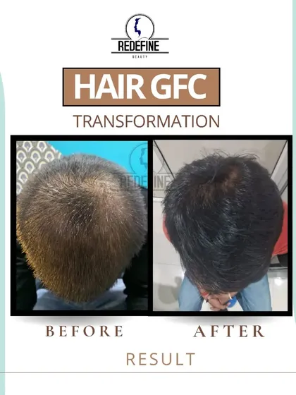 Another powerful example of a Hair GFC transformation. The comparison clearly shows how the treatment effectively covered the thinning area on the top of the scalp, resulting in fuller and denser hair.