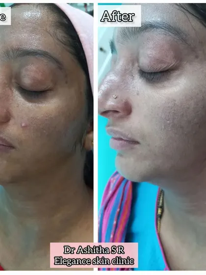Hyperpigmentation can be frustrating, but the right treatment makes all the difference. This patient saw a visible reduction in dark patches after a supervised treatment plan, avoiding the risks of harsh over the counter creams.