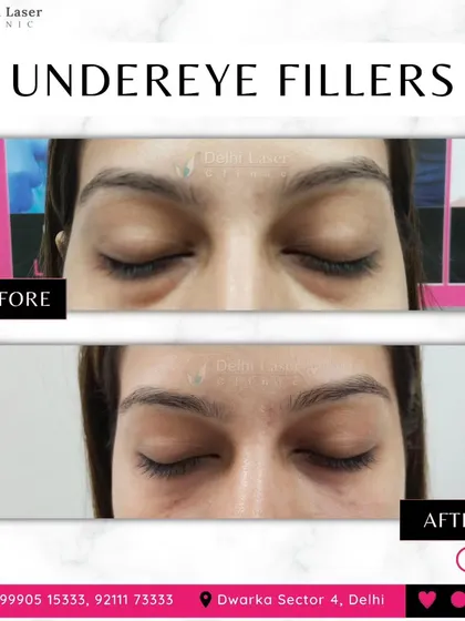 Hollow or dark under-eyes can make you look tired. This before and after shows how under-eye fillers can restore volume, reduce shadowing, and create a brighter, more rested appearance.