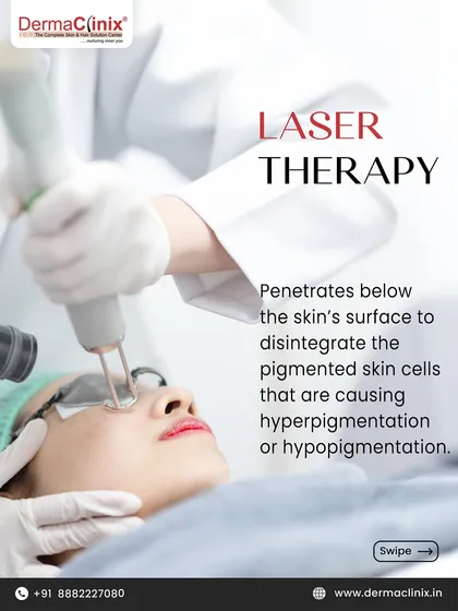 This image shows a laser therapy session for pigmentation. The laser penetrates below the skin's surface to break down pigmented cells that cause hyperpigmentation, leading to clearer skin.