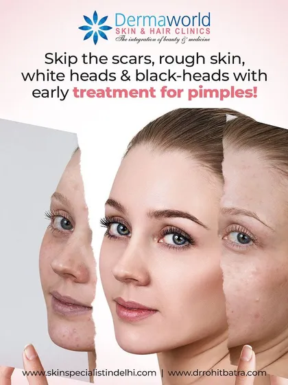 Don't wait for pimples to leave behind scars, rough skin, and blackheads. Early and effective treatment is the key to preventing long-term damage and maintaining a smooth, blemish-free complexion.