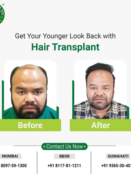 This before and after image shows a remarkable change. The client's hair is visibly fuller and his expression in the 'after' photo reflects his newfound confidence.