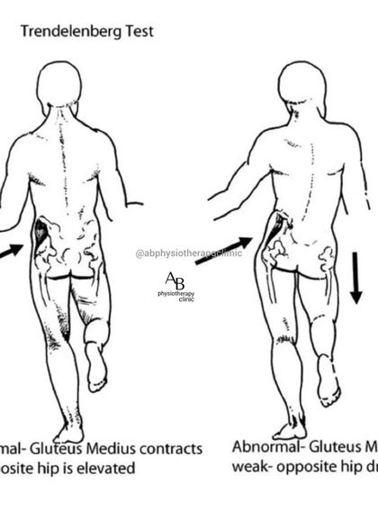 The Trendelenburg Test, shown here, helps me identify weakness in the hip abductor muscles. An abnormal gait can be a primary contributor to back and hip pain, which I address with specific strengthening exercises.