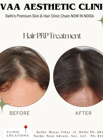 A clear before and after view of a client's scalp, demonstrating a visible reduction in the parting width and improved hair thickness. Our Hair PRP treatment effectively addresses diffuse hair thinning by stimulating dormant hair follicles.