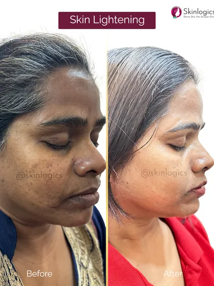 This image shows another successful skin lightening case. The 'after' photo demonstrates a visible reduction in overall skin darkness and a more even, healthy-looking skin tone.