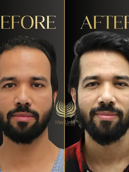 A powerful before and after transformation. We restored this patient's hair, giving him a fuller, more youthful look.