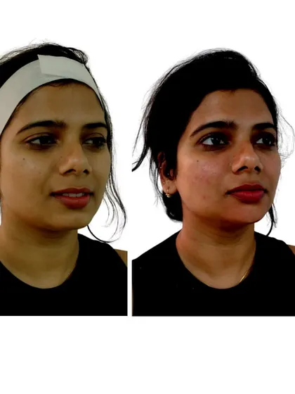 An instant glow-up after one of our customized medi-facials. This before and after shows the immediate improvement in skin brightness and texture after a single session.