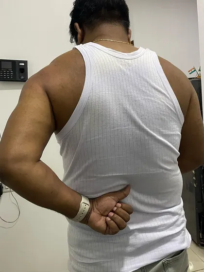 In the early stages of treatment, Mr. Hukum's internal rotation was severely restricted, a classic sign of frozen shoulder. This was our starting point.