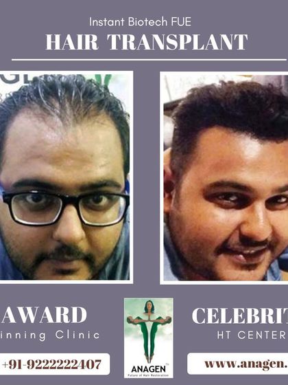 An astonishing result from our award winning clinic. This before and after photo shows a complete transformation from baldness to a full head of hair.