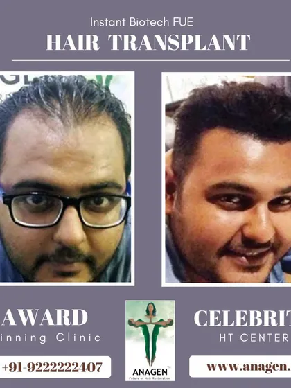 An astonishing result from our award winning clinic. This before and after photo shows a complete transformation from baldness to a full head of hair.