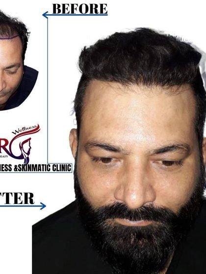 This client's transformation highlights how a restored hairline complements other facial features, like his full beard. The result is a powerful, confident, and balanced look.