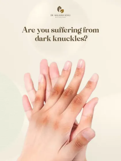 Darkening of the knuckles can be a cutaneous sign of an underlying systemic issue. It is important to investigate the cause, as it can be linked to various conditions that require medical evaluation.