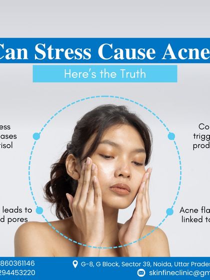 Can stress cause acne? This graphic explains the science. Stress increases cortisol, which boosts oil production and leads to clogged pores and inflammatory acne flare ups.