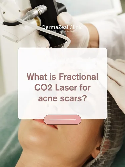 This image introduces the Fractional CO2 laser as a primary solution for acne scars, inviting you to learn more about how this advanced treatment can rebuild your skin.