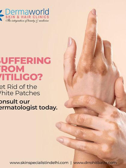 If you are suffering from vitiligo, which causes white patches on the skin, please consult a dermatologist. We can create a plan to manage the loss of pigmentation and help restore your confidence.