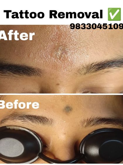 A before-and-after look at a forehead spot removal. The 'after' shows the skin healing after the laser treatment has broken down the pigment.