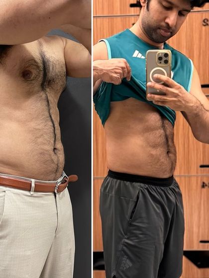 A personal progress photo showing my own results from a combination of workouts, diet, and device-based treatments. I practice what I preach, focusing on maintaining a healthy body fat percentage while preserving muscle.