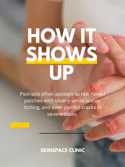 This is a classic presentation of psoriasis: red, raised patches with silvery-white scales. In severe cases, these patches can crack and become painful, highlighting the need for professional dermatological care.