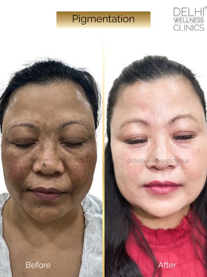 A full-face view of the pigmentation treatment results, showing a dramatic improvement in skin clarity and overall radiance.
