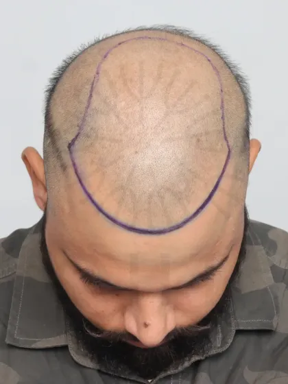 This shows the crucial first step: hairline design. We mark the area precisely to ensure the final result perfectly frames the face.