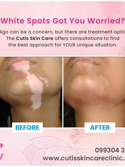 We specialize in compassionate and effective vitiligo treatment. This before and after result demonstrates how our personalized treatment plans can significantly restore skin pigmentation on the face, helping patients regain an even skin tone.