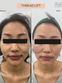 Anti-Aging & Facial Contouring