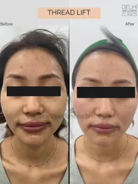 Anti-Aging & Facial Contouring