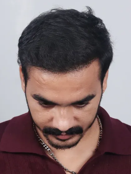 A complete 10-month transformation for a Diffuse Grade 5A case. We recreated the hairline and added density to the frontal and mid-scalp with 3,800 grafts.