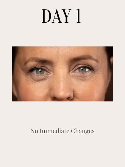 Clinic Next Face - Cosmetic Injectables Botox Treatments: Smooth Wrinkles & Refine Contours photo 14