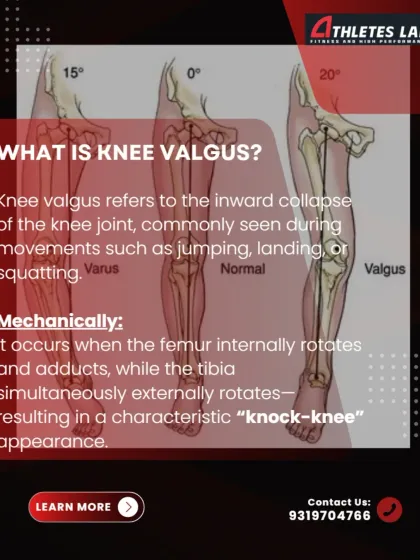This graphic defines knee valgus mechanically, explaining how the inward collapse occurs due to a combination of femoral internal rotation and tibial external rotation, creating the characteristic "knock-knee" appearance during movements like squats and jumps.