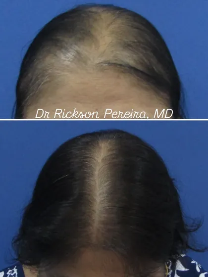 This before and after shows the significant hair regrowth possible for advanced Female Pattern Hair Loss (FPHL). My science-led treatment plans, combined with patient consistency, can achieve remarkable improvements in hair density and scalp coverage.
