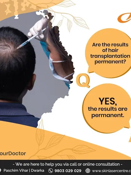 A common question I get is whether hair transplant results are permanent. The answer is yes. The Follicular Unit Extraction (FUE) procedure we perform provides a permanent hair regrowth solution, giving you a completely natural look.