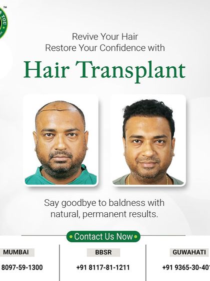 "Revive your hair, restore your confidence." This before and after image perfectly illustrates this motto, showing a client who has regained a full, natural-looking head of hair.