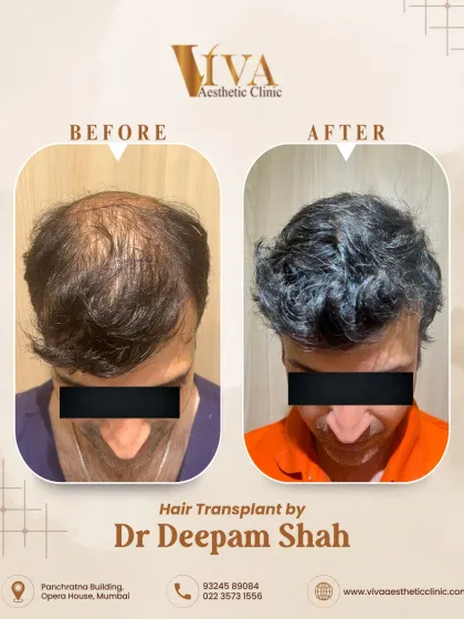 This patient's concern was thinning on the mid-scalp and crown. This before-and-after shows the one-year result, where we successfully filled in the thinning areas for a much fuller look.