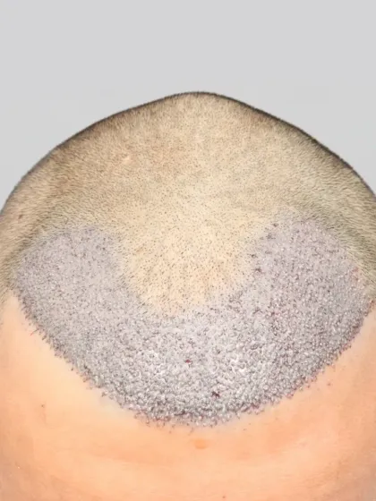 Precision in every graft. A close-up of a 2200 graft placement for a Grade 2 baldness case, focusing on a natural and dense hairline.