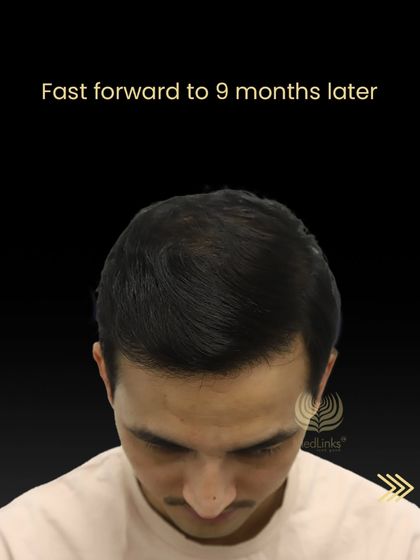 Nine months later, Tika Ram has a full head of hair, showcasing the excellent progress and final result.