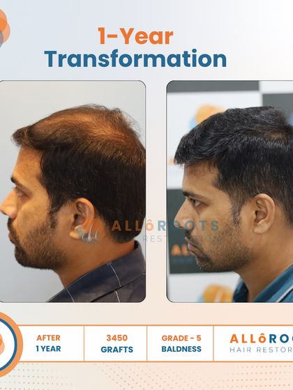 This is a one-year transformation for a Grade 5 baldness case, achieved with 3450 grafts. The before and after photos from various angles show a comprehensive restoration of the scalp, resulting in a full and natural look.