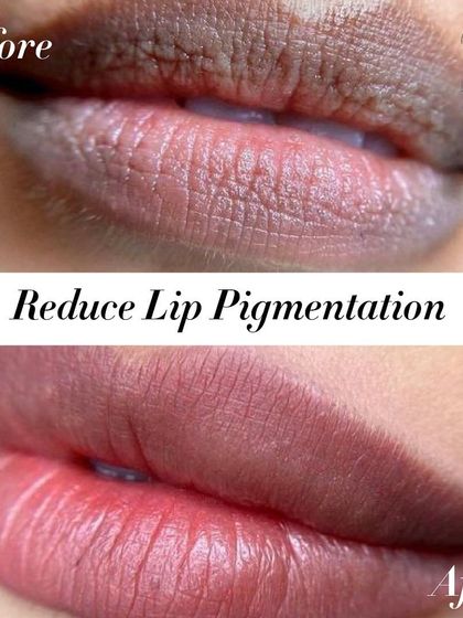 A powerful before and after showing the reduction of lip pigmentation, achieving a more even and natural lip color without lipstick.