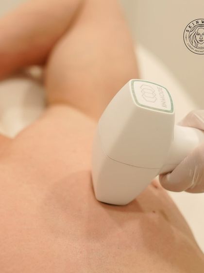 A close-up view of the InMode laser device during a chest hair reduction treatment. The technology is precise, targeting hair follicles without affecting the surrounding skin, which is why it is so safe and effective.