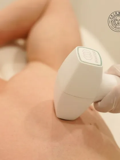 A close-up view of the InMode laser device during a chest hair reduction treatment. The technology is precise, targeting hair follicles without affecting the surrounding skin, which is why it is so safe and effective.