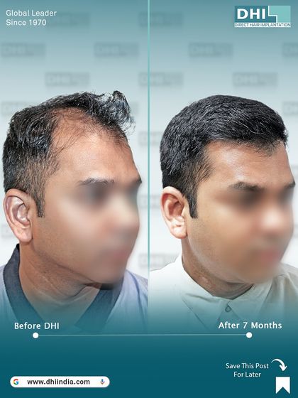 Another side-view of the 7-month transformation. This image showcases the comprehensive coverage from the front to the mid-scalp, a result of the strategic placement of 8,226 hairs.