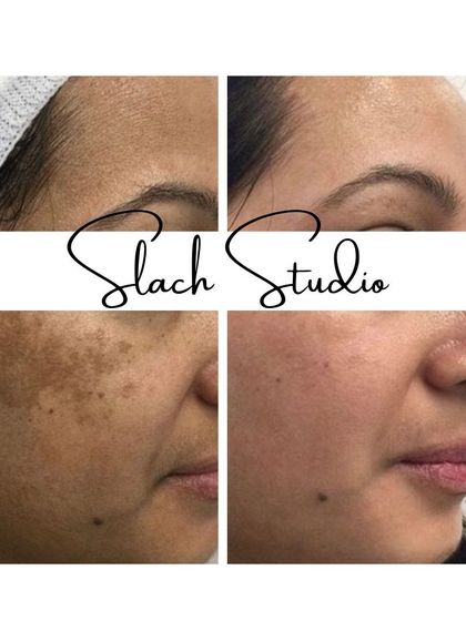 This collage demonstrates the treatment's power to erase sun damage and pigmentation, restoring a youthful and even skin tone.