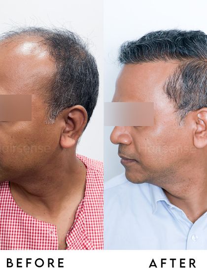 The right-side profile demonstrates the even distribution of grafts, creating a consistent and full look all around the scalp.