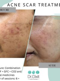 Acne & Scar Treatment