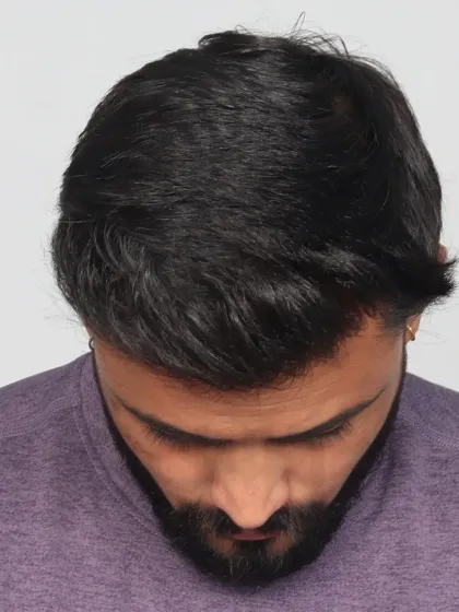 A stunning 12-month transformation for a Grade 3 baldness case. We used 3000 grafts for a personalized hairline, temple reconstruction, and dense frontal coverage.