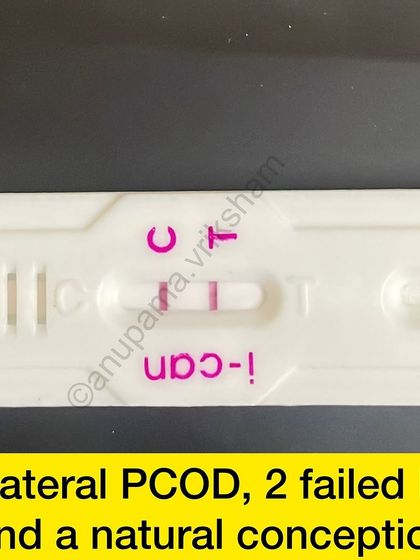 This is a wonderful result for a student with bilateral PCOD and 2 failed IUIs. She followed the diet and exercise guidance strictly and conceived naturally.