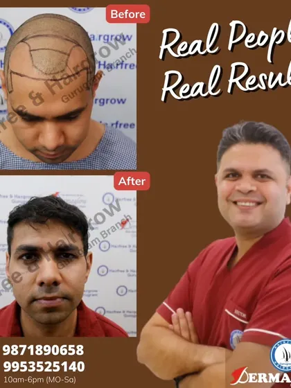 After 11 months, this client's 3000-graft hair transplant has yielded incredible results. The 'before' photo shows the pre-operative markings for hairline design, and the 'after' photo displays the full, natural-looking outcome.