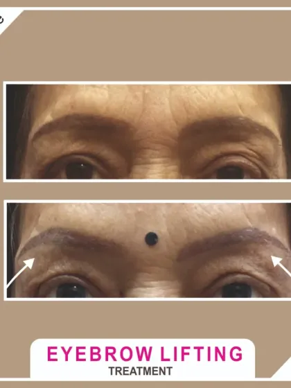 An instant lift for tired-looking eyes. This before and after shows the subtle but effective results of a non-surgical eyebrow lifting treatment, which helps to open up the eye area for a more refreshed and youthful appearance.