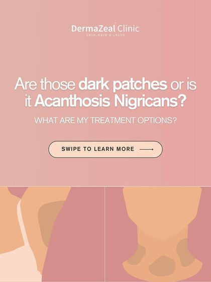 Are those dark patches on your skin Acanthosis Nigricans? This guide explains the condition and the procedural options available for treating it.